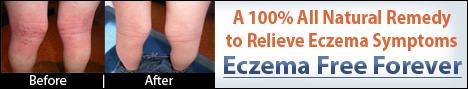 eczema remedy