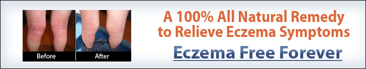 Eczema treatment