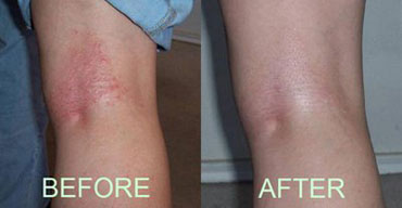 Keath Florence Eczema Before & After